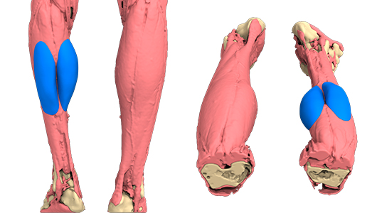 3D-Rekonstruktion der Wadenatrophie des Patienten mit einem maßgeschneiderten 3D-Implantat
