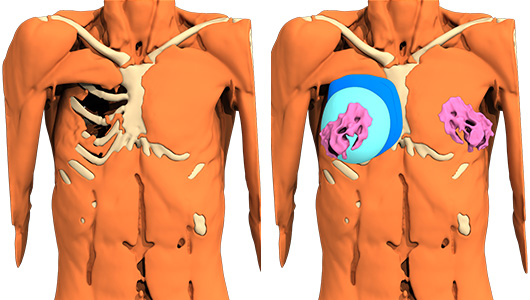 3D-Rekonstruktion des Poland-Syndroms des Patienten und 3D-Konstruktion des maßgeschneiderten Implantats