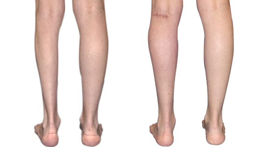 Before/after result of a calf atrophy treatment with 3D custom-made implant