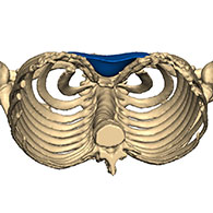 3D-Ansicht Pectus Excavatum mit Implantat - typ 1