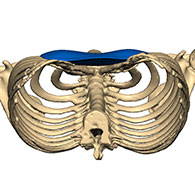 3D-Ansicht Pectus Excavatum mit Implantat - typ 2