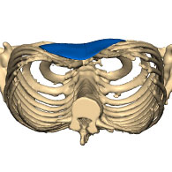 3D-Ansicht Pectus Excavatum mit Implantat - typ 3