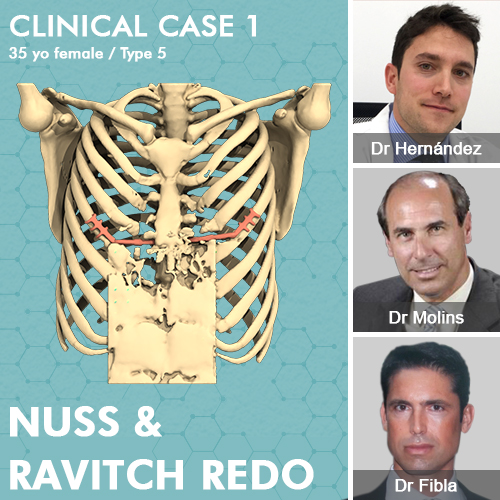 Clinical case of successive failure of Ravitch and Nuss redo