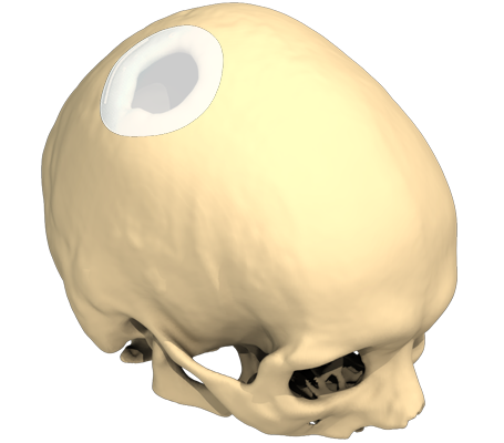 Vue d'un design 3D d'un implant 3D sur-mesure pour trou dans le crâne