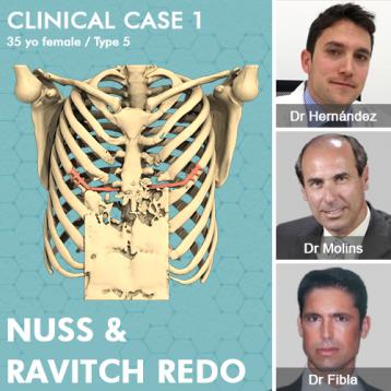Caso clinico: revisione di Nuss e Ravitch da parte di Molins-Hernández-Fibla