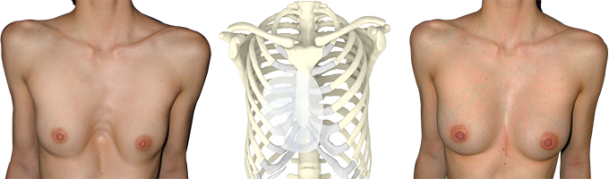 Design 3D d'un implant 3D sur-mesure Design 3D d'un implant 3D sur-mesure