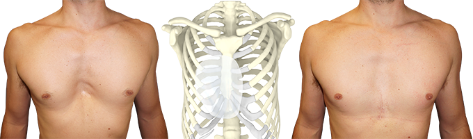 Avant après implant 3D chez l'homme Avant après implant 3D chez l'homme