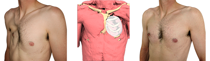 Vorher/Nachher-Foto des mit einem 3D-Implantat behandelten Poland-Syndroms Vorher/Nachher-Foto des mit einem 3D-Implantat behandelten Poland-Syndroms