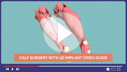 Video de cirugía de atrofia de la pantorrilla con un implante 3D personalizado