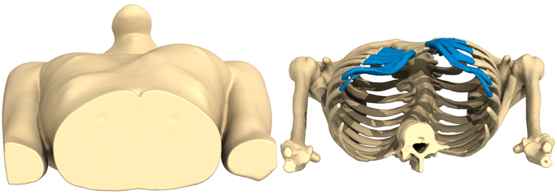 3D view of a deep lateral Pectus Excavatum
