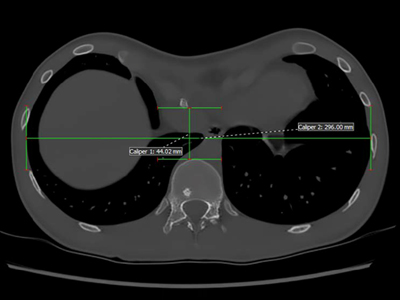 Chest Ct showing a Haller index of 6.7