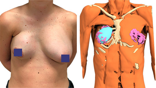 Foto der Brustdeformation der Patientin durch das Poland-Syndrom und des fehlgeschlagenen Versuchs, diese mit einem Brustimplantat zu korrigieren