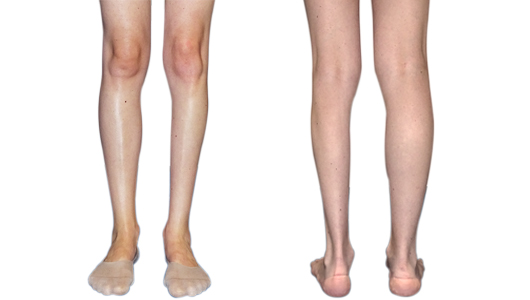 Front and back view of a calf atrophy on a woman