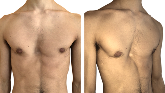 Pectus excavatum - insufficient result after a first corrective intervention with Nuss technique