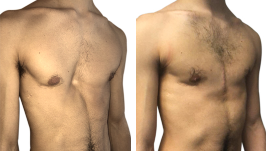 Resultado antes y después de un mes después de la cirugía con prótesis 3D a medida 2