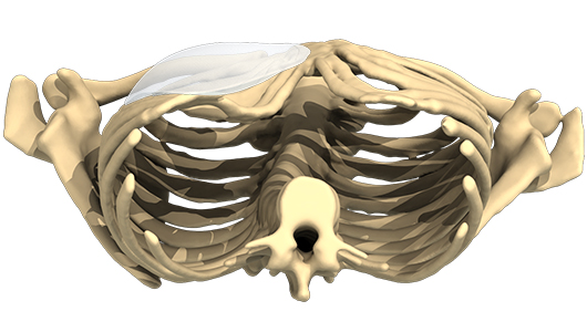 Vue 3D en contre-plongée d'un implant pour traiter un thorax en entonnoir