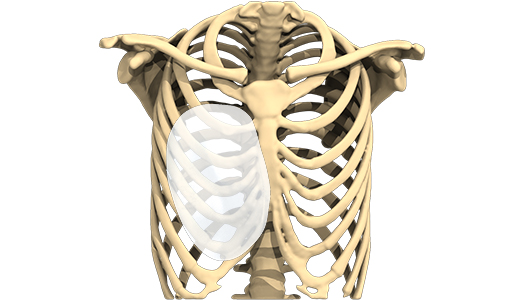 Vue 3D d'un implant pour traiter un thorax en entonnoir