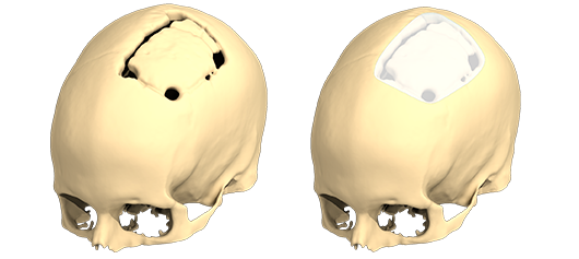 Image avant après d'une cranioplastie pour combler une déformation du crâne