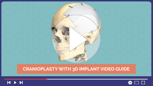 Vidéo de cranioplastie avec implant 3D sur-mesure