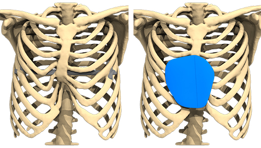 Imagen de planificación preoperatoria estudiada en el ordenador, sobre la reconstrucción con un implante 3D a medida