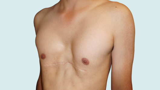 Risk of residual Pectus Excavatum after Ravitch surgery