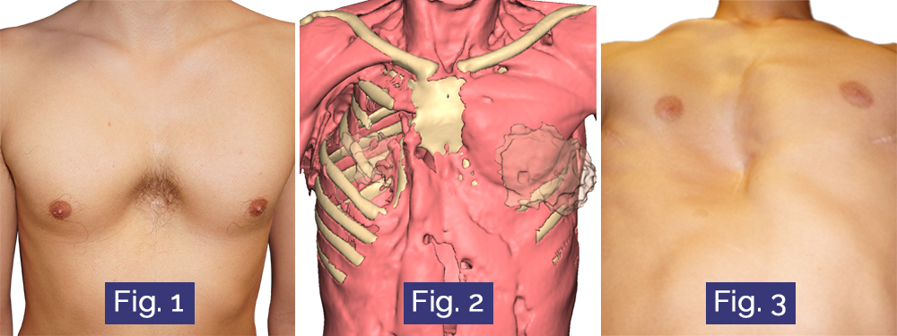Images de Pectus arcuatum, Pectus/Poland hybride et échec de Nuss Images de Pectus arcuatum, Pectus/Poland hybride et échec de Nuss