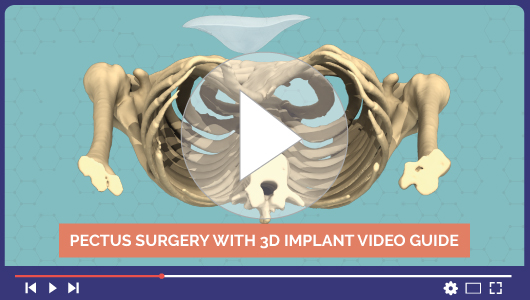 Vidéo Chirurgie du Pectus Excavatum par implant 3D sur-mesure