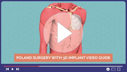 Vidéo Chirurgie du Syndrome de Poland par implant 3D sur-mesure