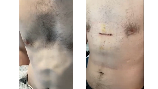 Résultat de la chirurgie secondaire avec implants 3D sur-mesure pour Pectus après échec de la technique de Ravitch