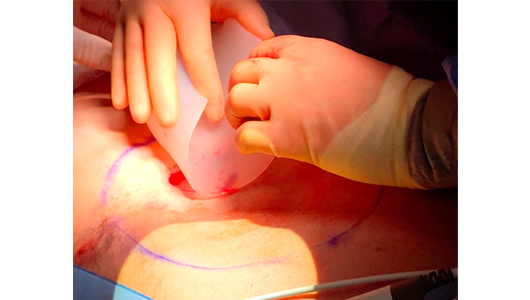 Insertion de l'implant 3D sur-mesure dans le plan sous cutané pendant la chirurgie du Pectus