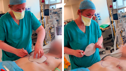 Le Pr Redmond dessinant le contour du prototype sur le patient pour préparer la chirurgie de reprise du Pectus Excavatum avec les implants 3D sur-mesure