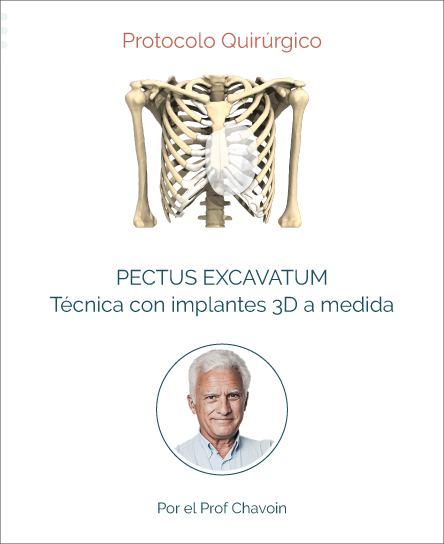 Surgery protocol for Pectus Excavatum with implant technique