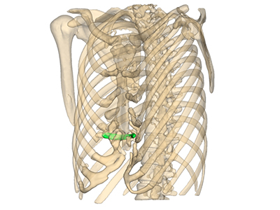 Reconstrucción 3D del tórax que muestra la ubicación de la malla de prolene, visto en 3/4