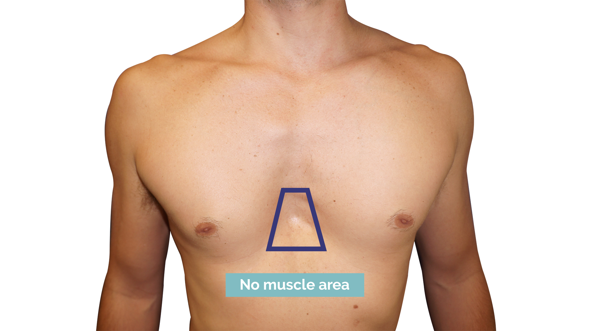 Photo of a Pectus focusing on the non-muscular area Photo of a Pectus focusing on the non-muscular area