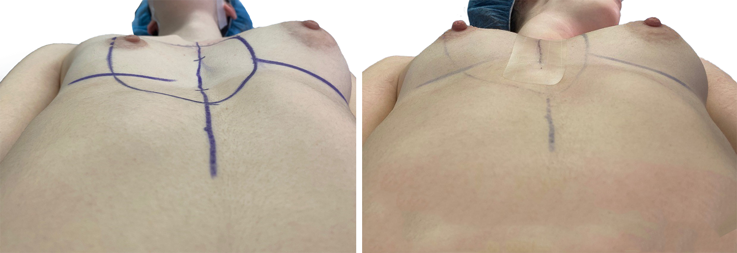 Before/after picture of a woman’s pectus, perOp Before/after picture of a woman’s pectus, perOp