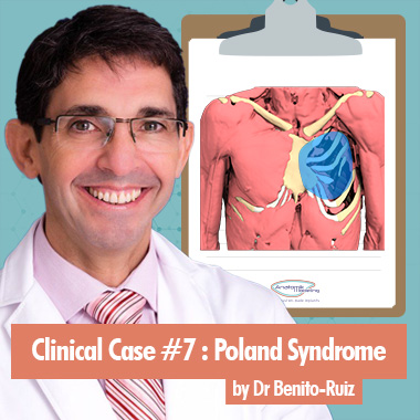 Cas clinique 7 : Traitement du Syndrome de Poland par le Dr Benito-Ruiz