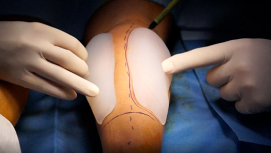 Opération de l'atrophie du mollet avec implant 3D sur-mesure