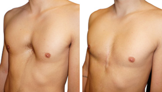 Before/After picture of a male Pectus Excavatum