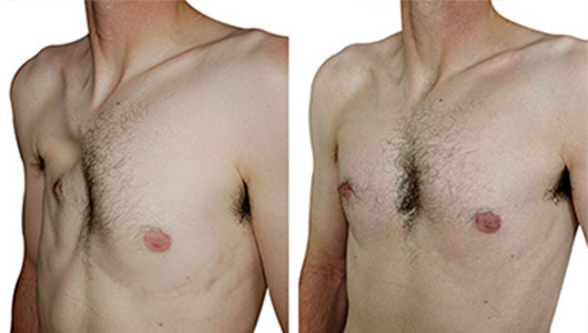Before/After picture of a male Poland Syndrome