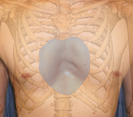 Male torso with a Pectus Excavatum and an implant