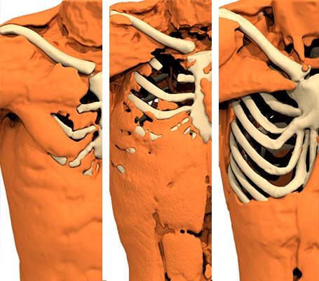 3D view of different Poland Syndrome