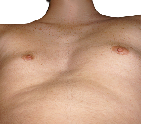 Extended and asymmetrical Pectus (Type 3)