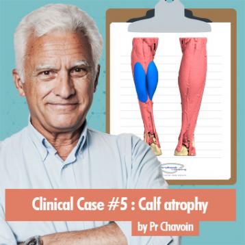Clinical Case : calf atrophy by Prof. Chavoin