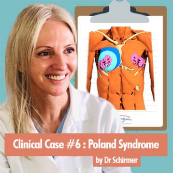 Caso clínico 6 : Revisión de Síndrome de Poland por la Dra. Claudia Schirmer