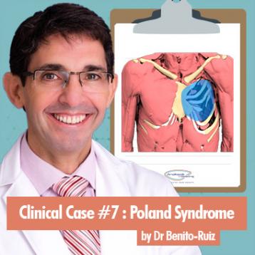 Caso clínico del Dr Benito sobre el sindrome de Poland