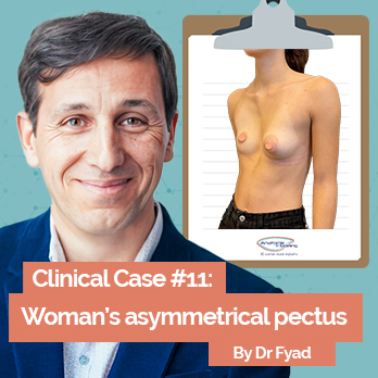 Clinical Case: Asymmetric Pectus treatment by Dr Fyad