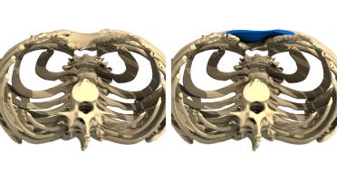 Woman - Pectus Type 4 - 1 year later - 3D view