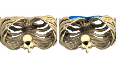 Woman - Pectus Type 5 -2 years later - 3D view